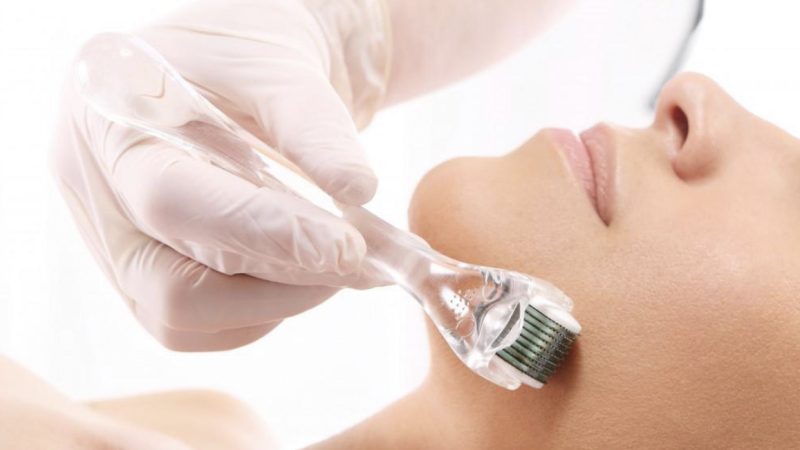 Microneedling Facial