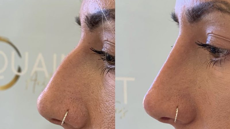 Non-surgical rhinoplasty